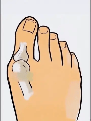 Bunion Corrector Adjustable Medically Tested ABS Set of 2
