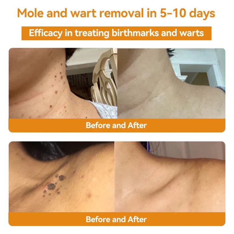 Skin Tag Removal Spray with Natural Bee Venom Extract for At-Home Treatment of Tags, Warts & Moles