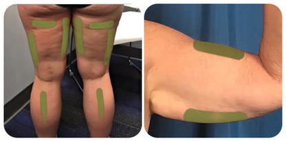 Patch for Reducing Cellulite - Natural Formula