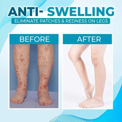 Leg Vein Treatment Kit Medical-Grade Blue Light & Cream