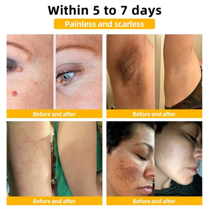 Skin Tag & Wart Removal Spray with Natural Bee Venom Extract for Blemish-Free Complexion at Home Treatment