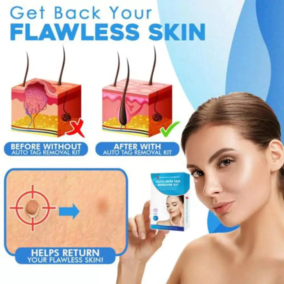 Aero Tag Remover Kit | Pain-Free Skin Tag Solution