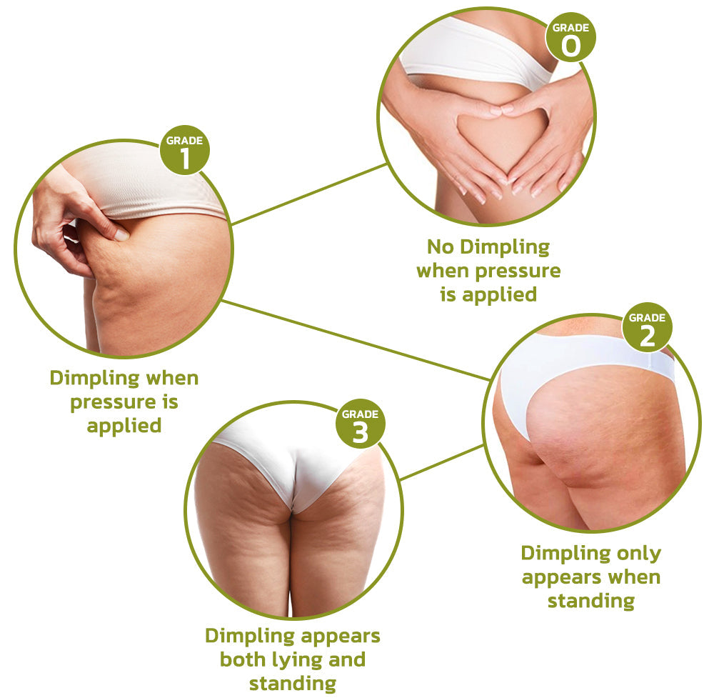 Patch for Reducing Cellulite - Natural Formula