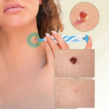 DermaLinx | Wart Remover for Pain-Free Skin Treatment | Effective Solution for Smooth Skin