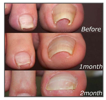 Toenail Alignment Strips for Smooth Appearance | Self-Adhesive Nail Care Patches | Easy Application for Groomed Toenails at Home
