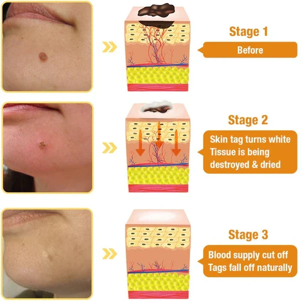 Skin Tag Removal Spray with Natural Bee Venom Extract for At-Home Treatment of Tags, Warts & Moles