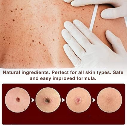 Skin Tag & Wart Removal Pen with Precision Applicator Tip for Spot Treatment at Home | Natural Plant-Based Formula