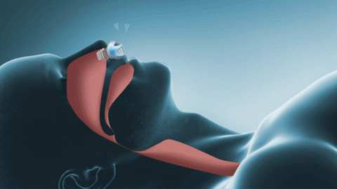 BREATHNEST – Sleep Apnoea Device for Comfortable Rest