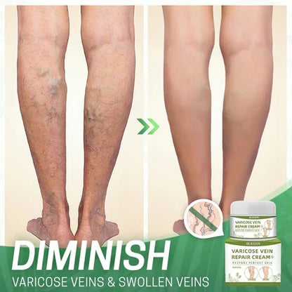 Varicose Vein Cream Herbal Extracts Skin Firming