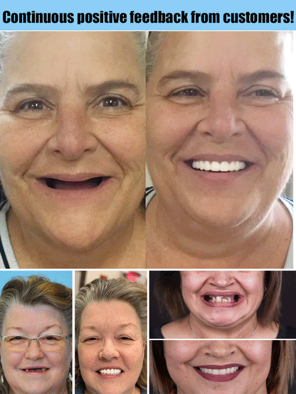 Moldable Cosmetic Dental Veneers Upper & Lower Set Reusable Snap-On Smile Kit for Instant Confidence Natural Look Temp Teeth Cover
