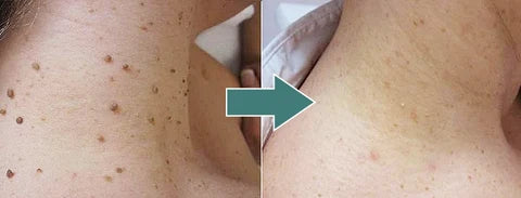 Skin Tag Patches Hydrocolloid & Salicylic Acid 36 Pack