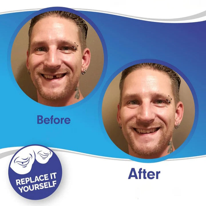 Easy Fit Clip On Smile Veneers Upper Lower Teeth