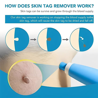 Easy Skin Tag Removal Kit with Applicator