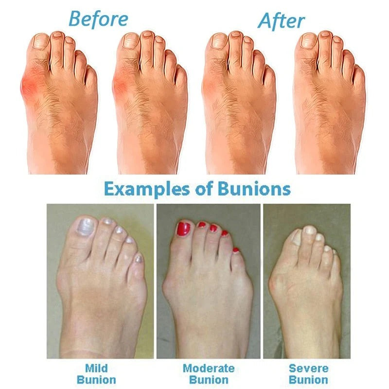 Supportive Arch Sandals for Men and Women with Toe Spacer