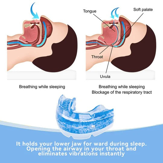 Adjustable Anti-Snoring Mouthpiece for Better Sleep | Custom-Fit Jaw Alignment Guard | BPA-Free Heat-Moldable Design for Nighttime Use | Reu