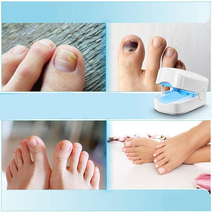 Portable Laser Treatment Pen for Toenail Fungus – 7-Minute Light Therapy Device for Nail Health & Clarity at Home
