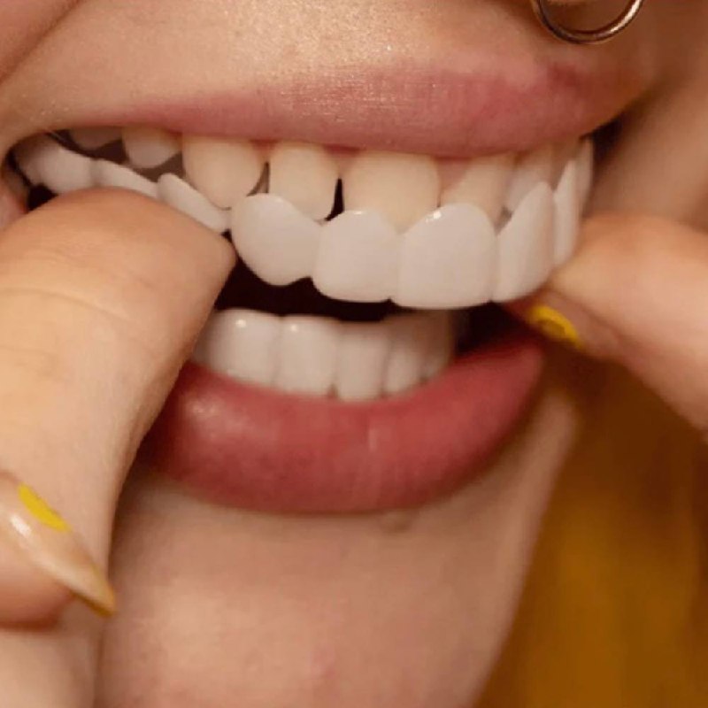 Easy Teeth Veneer Kit for Perfect Smile