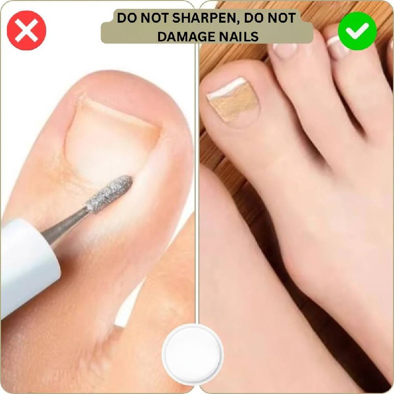 Fast Nail Fix for Broken and Ingrown Nails