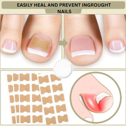 Fast Nail Fix for Broken and Ingrown Nails